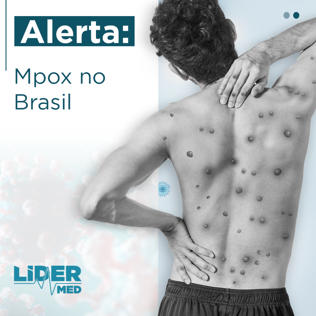 No Brasil, o Ministério da Saúde está em alerta, e na quinta-feira, 15 de agosto, instalou um Centro de Operações de Emergência em Saúde (COE) para coordenar as ações de resposta à Mpox. O COE terá o papel de monitorar a evolução da doença no Brasil e seguir as orientações da OMS e outras instituições internacionais.